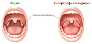 Значение небных миндалин