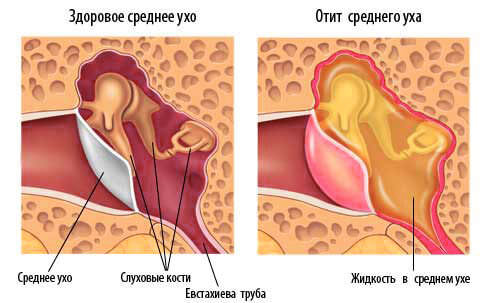 Перекись водорода и отит