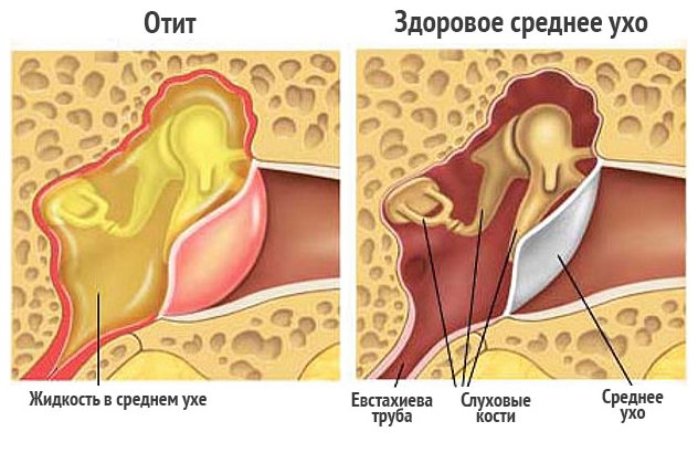 Симптомы отита