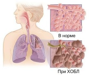 Обструкция дегких и лечение заболевания
