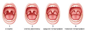 Степени гипертрофии небных миндалин